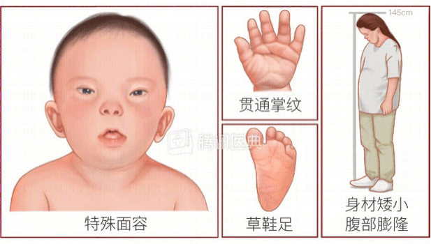 新生儿染色体异常会有哪些典型症状？家长该如何早期识别与应对？-第3张图片-郑州医学网