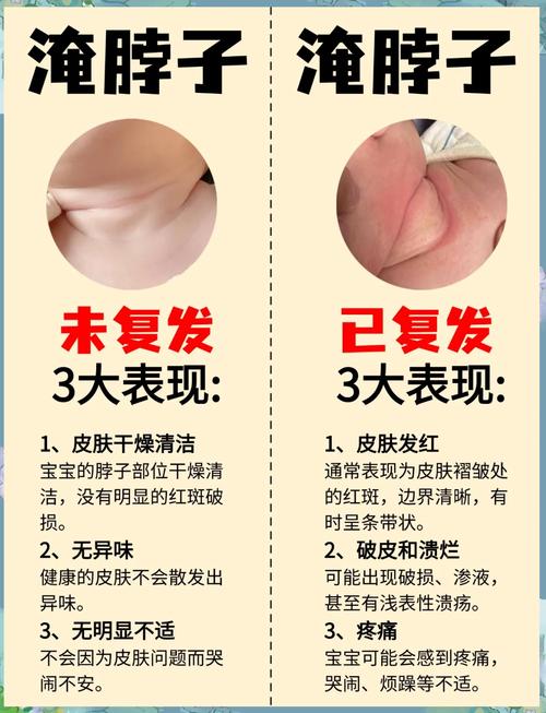 新生儿洗澡时淹破皮了，该怎么正确处理才能避免感染？-第1张图片-郑州医学网