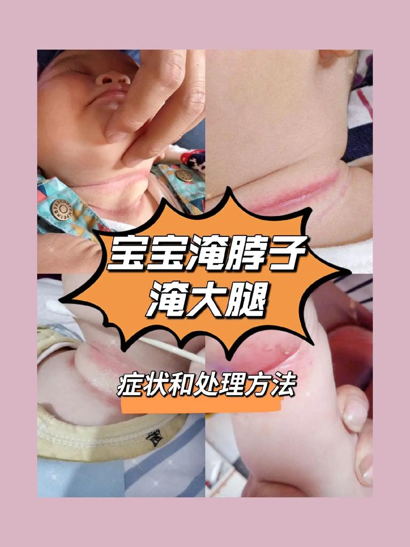 新生儿洗澡时淹破皮了，该怎么正确处理才能避免感染？-第2张图片-郑州医学网