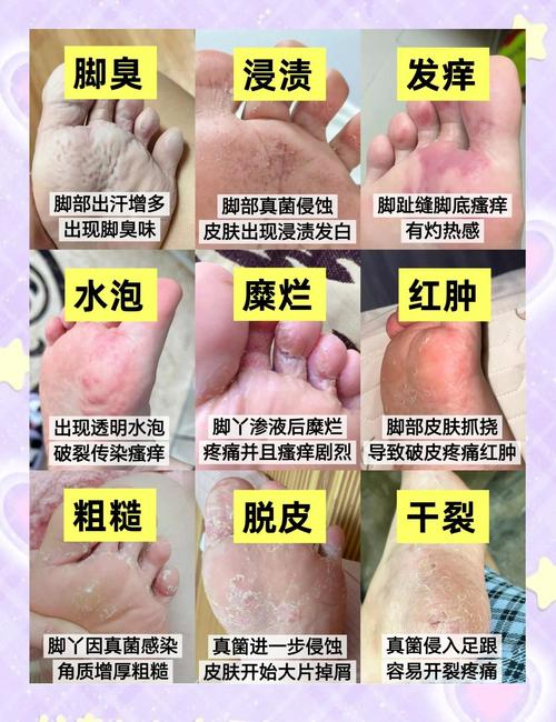 孕期感染脚气了怎么办？用药会不会影响胎儿健康？-第1张图片-郑州医学网