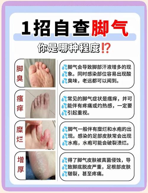 孕期感染脚气了怎么办？用药会不会影响胎儿健康？-第2张图片-郑州医学网