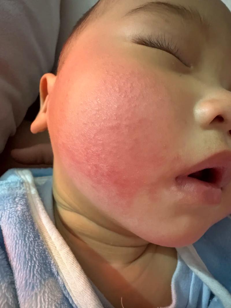 新生儿脸上长痱子怎么快速消退？日常护理要注意这几点！-第3张图片-郑州医学网