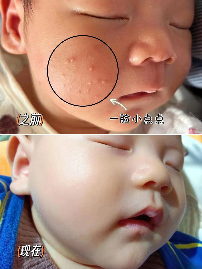 新生儿脸上长痱子怎么快速消退？日常护理要注意这几点！-第1张图片-郑州医学网