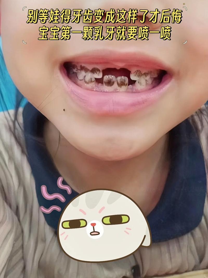 儿童牙齿后面长出新牙是正常现象还是牙齿发育异常？-第2张图片-郑州医学网
