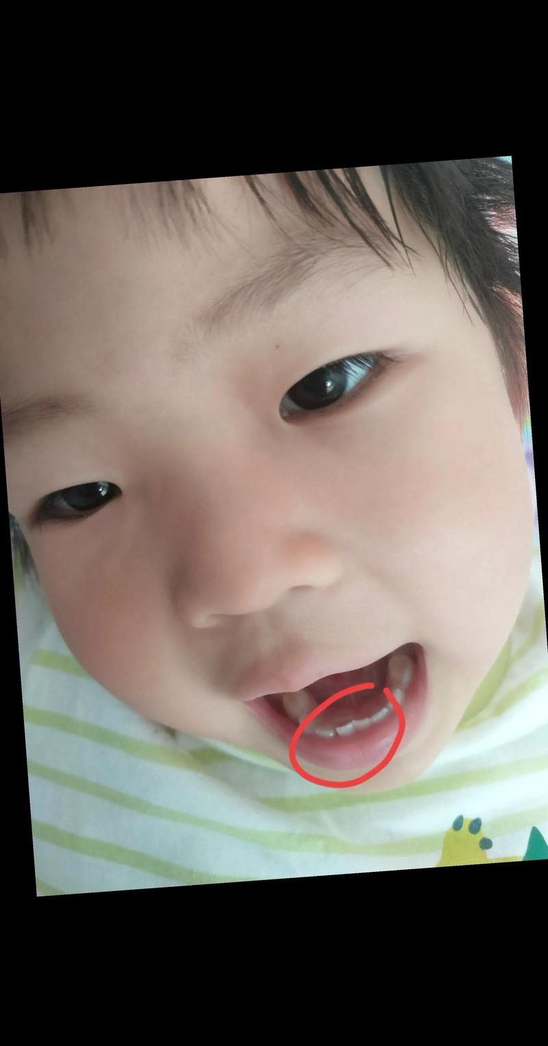 儿童牙齿后面长出新牙是正常现象还是牙齿发育异常？-第1张图片-郑州医学网