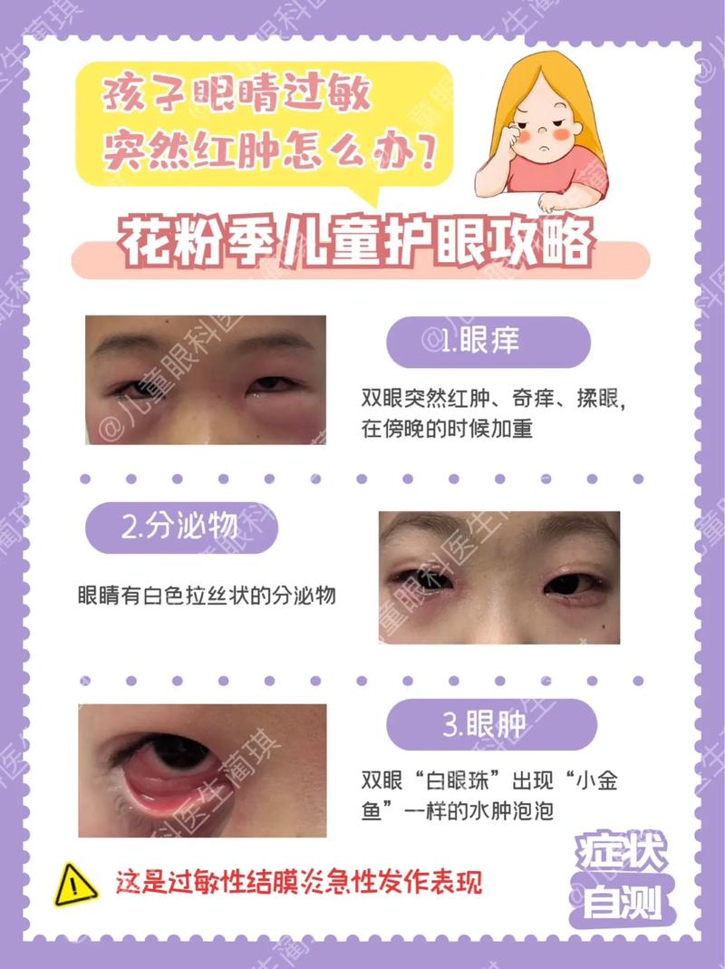 儿童眼睛浮肿是肾病信号？别忽视这些潜在健康风险！-第1张图片-郑州医学网