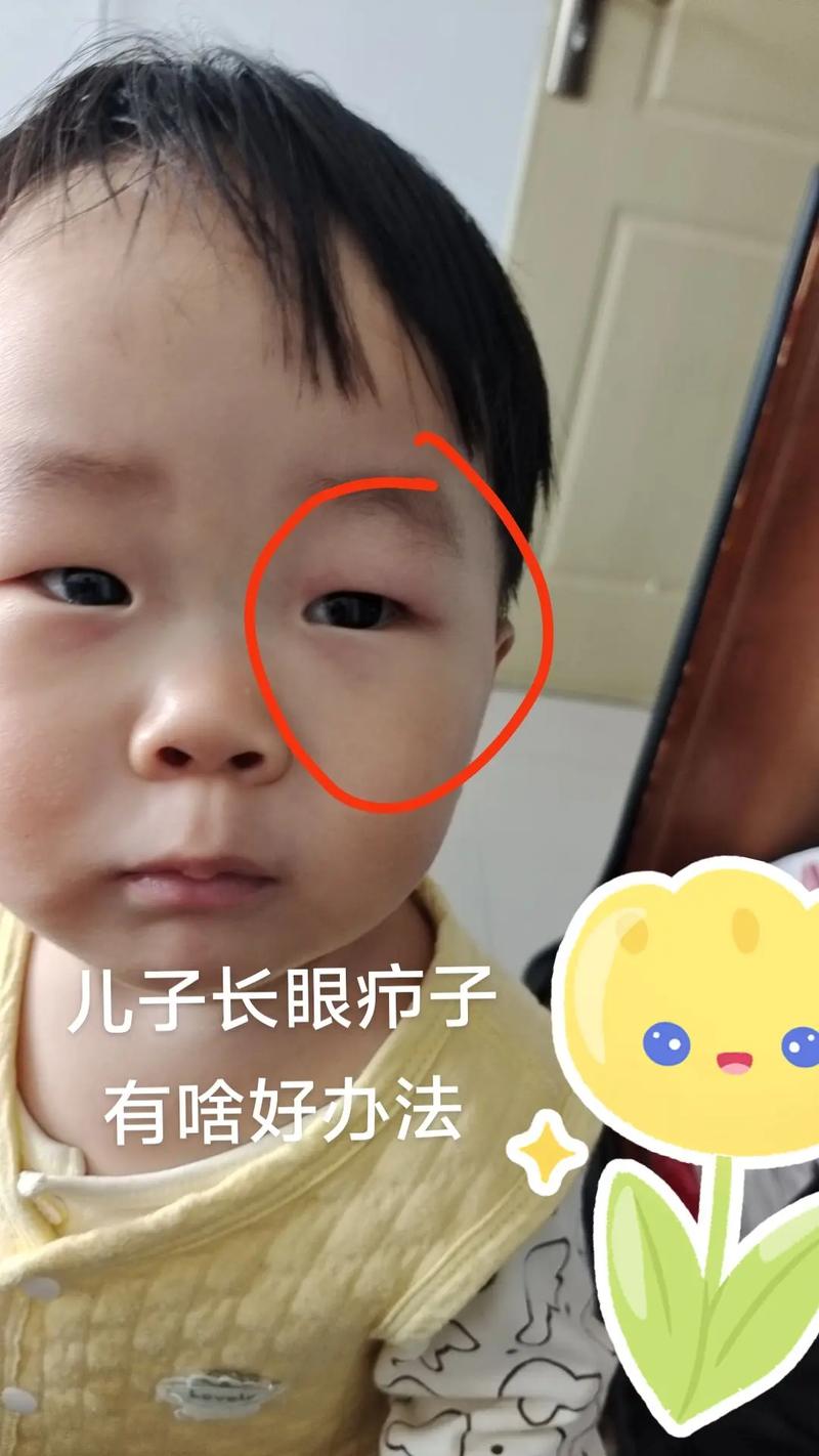 儿童眼睛浮肿是肾病信号？别忽视这些潜在健康风险！-第3张图片-郑州医学网