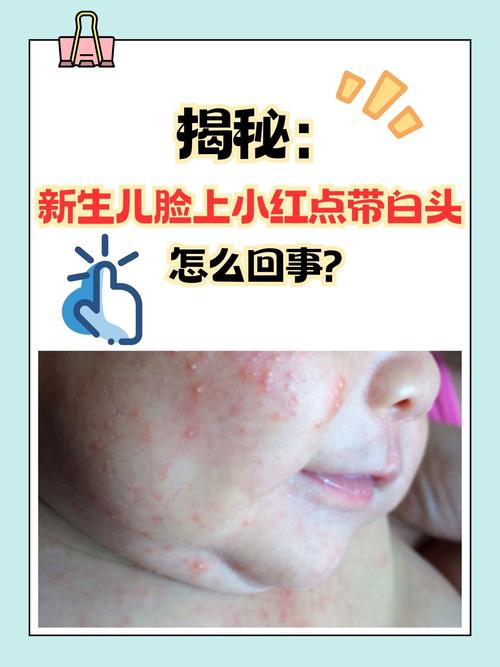 新生儿用红霉素安全吗？哪些情况需要用？有没有替代药？-第2张图片-郑州医学网