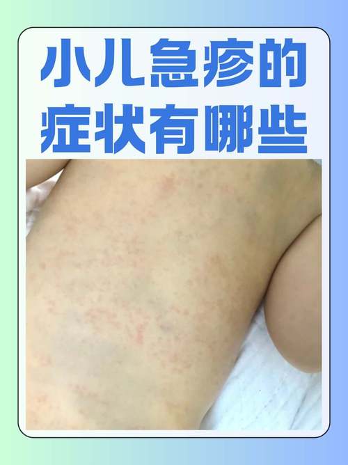 新生儿常见病有哪些？新手爸妈必知的健康预警信号与应对指南-第1张图片-郑州医学网