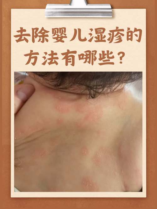 新生儿常见病有哪些？新手爸妈必知的健康预警信号与应对指南-第2张图片-郑州医学网