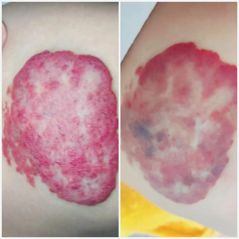 新生儿血管瘤激光治疗安全吗？会不会留疤？最佳治疗时间是什么时候？-第1张图片-郑州医学网