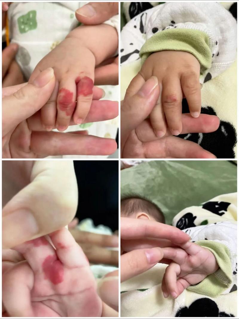新生儿血管瘤激光治疗安全吗？会不会留疤？最佳治疗时间是什么时候？-第2张图片-郑州医学网