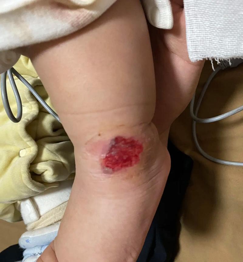 新生儿血管瘤激光治疗安全吗？会不会留疤？最佳治疗时间是什么时候？-第3张图片-郑州医学网