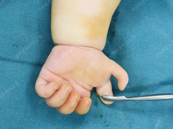 新生儿六指畸形究竟是如何形成的？背后隐藏着哪些遗传与环境因素？-第3张图片-郑州医学网