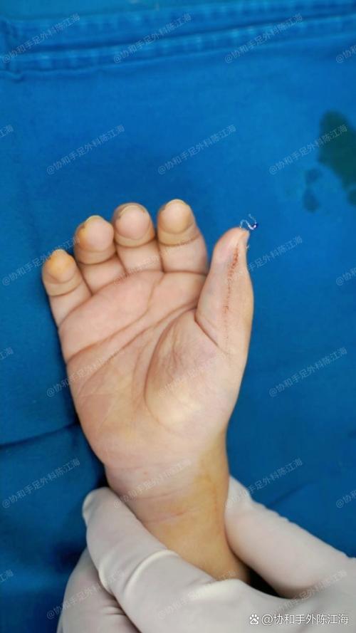 新生儿六指畸形究竟是如何形成的？背后隐藏着哪些遗传与环境因素？-第1张图片-郑州医学网