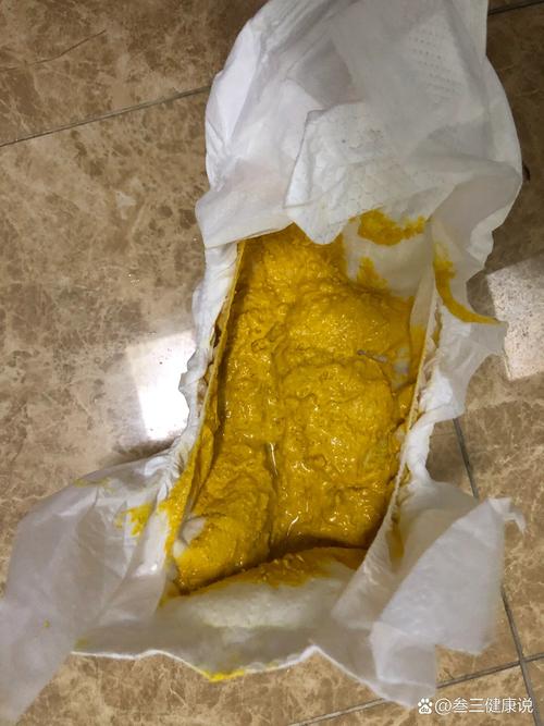 新生儿拉的粑粑有点稀,是正常现象还是消化不良的信号?-第1张图片-郑州医学网 新生儿拉的粑粑有点稀,是正常现象还是消化不良的信号?-第1张图片-郑州医学网