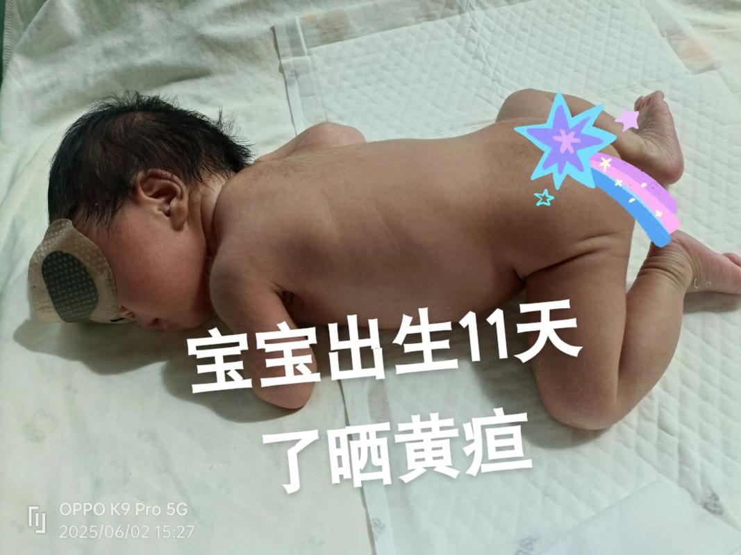 新生儿黄疸退了又复发，是正常反复还是病理性信号？需警惕哪些潜在风险？-第2张图片-郑州医学网