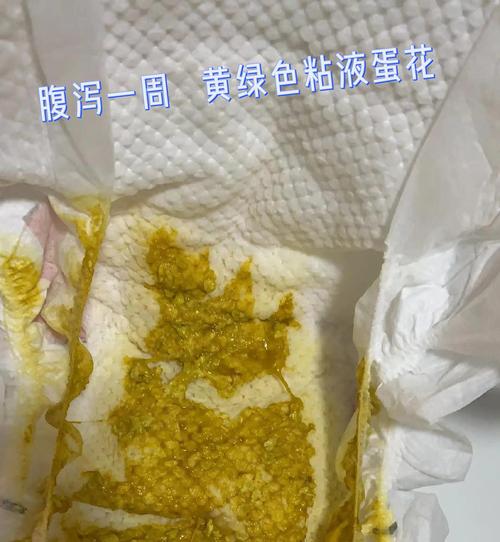 新生儿拉肚子是细菌感染吗？如何判断与应对？-第3张图片-郑州医学网