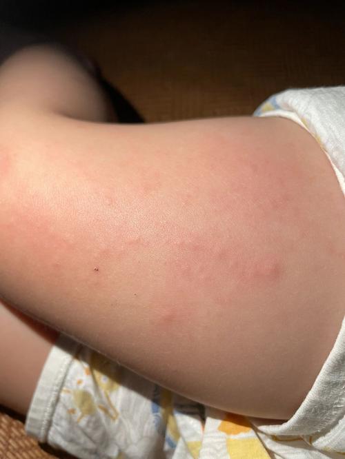 新生儿大腿根部湿疹反复发作怎么办？日常护理要注意这几点吗？-第1张图片-郑州医学网