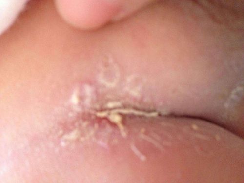 新生儿大腿根部湿疹反复发作怎么办？日常护理要注意这几点吗？-第2张图片-郑州医学网