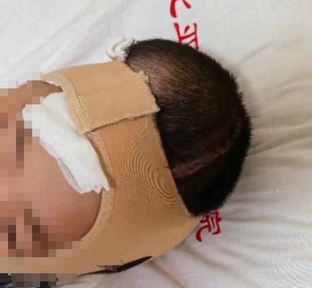 新生儿左侧侧脑室出血会留下后遗症吗？如何治疗与干预？-第1张图片-郑州医学网