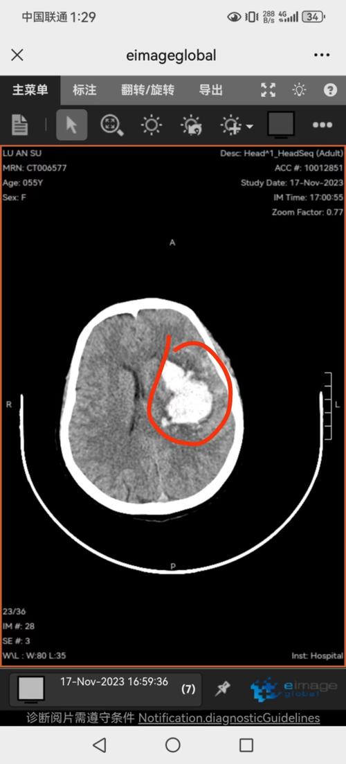 新生儿左侧侧脑室出血会留下后遗症吗？如何治疗与干预？-第2张图片-郑州医学网