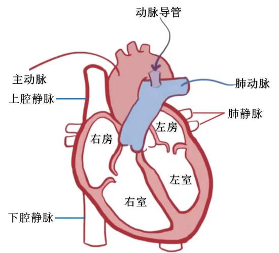 新生儿动脉导管未闭会导致哪些健康风险？如何判断与处理？-第2张图片-郑州医学网