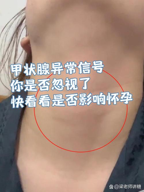 孕期甲状腺激素偏低会影响胎儿发育吗？该如何科学调理与监测？-第1张图片-郑州医学网