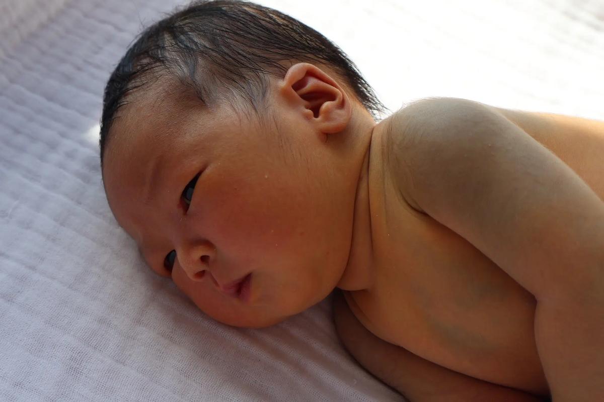 新生儿11天黄疸19mg/dl需要立即干预吗？母乳喂养会影响黄疸消退吗？-第3张图片-郑州医学网