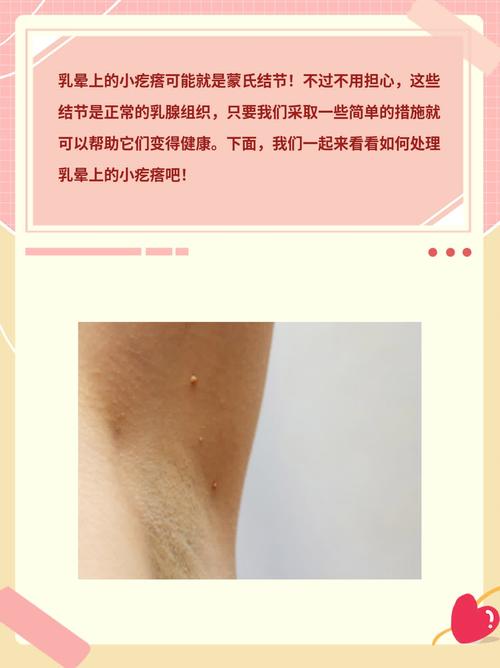 孕期乳晕长了小肉疙瘩-第1张图片-郑州医学网