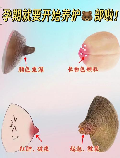 孕期乳晕长了小肉疙瘩-第3张图片-郑州医学网