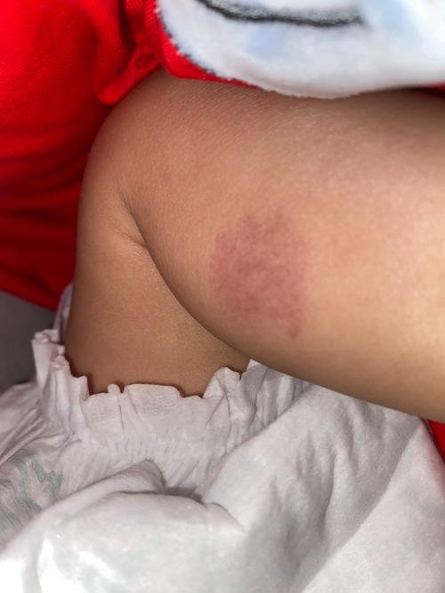 儿童大腿内侧红斑图片是什么原因引起的？需要警惕哪些疾病？-第2张图片-郑州医学网