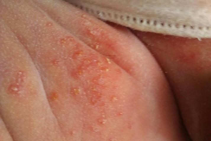 儿童大腿内侧红斑图片是什么原因引起的？需要警惕哪些疾病？-第1张图片-郑州医学网