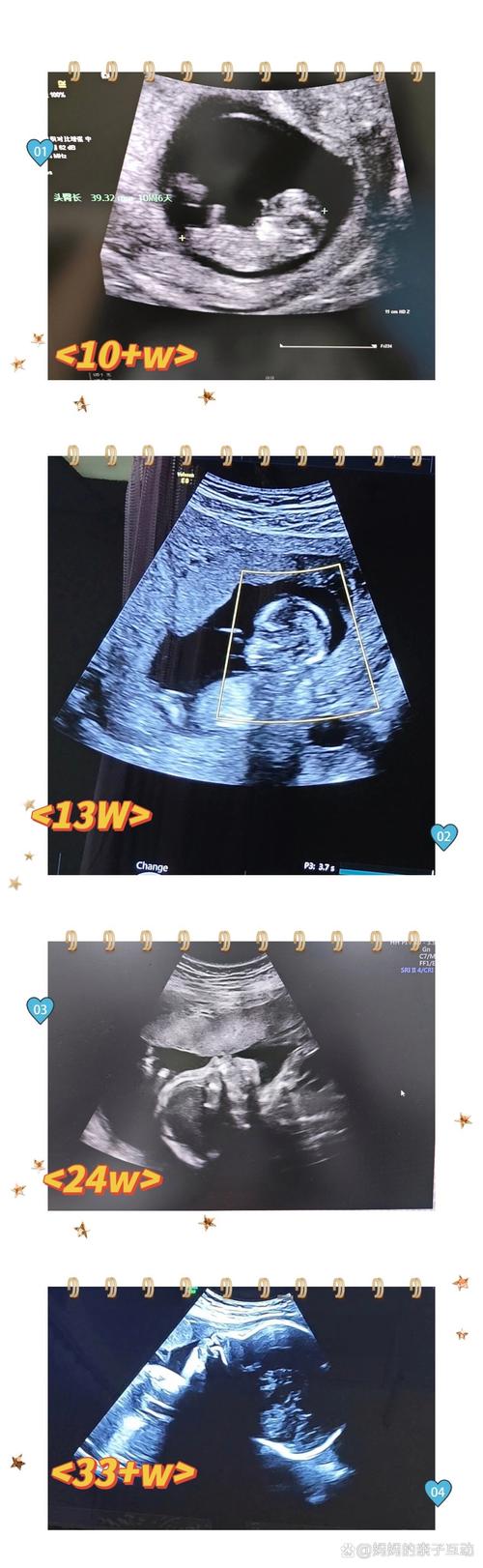 儿童肝脏超声正常大小-第2张图片-郑州医学网