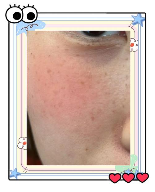 儿童脸上晒斑怎么有效消除？日常护理与专业方法有哪些？-第2张图片-郑州医学网