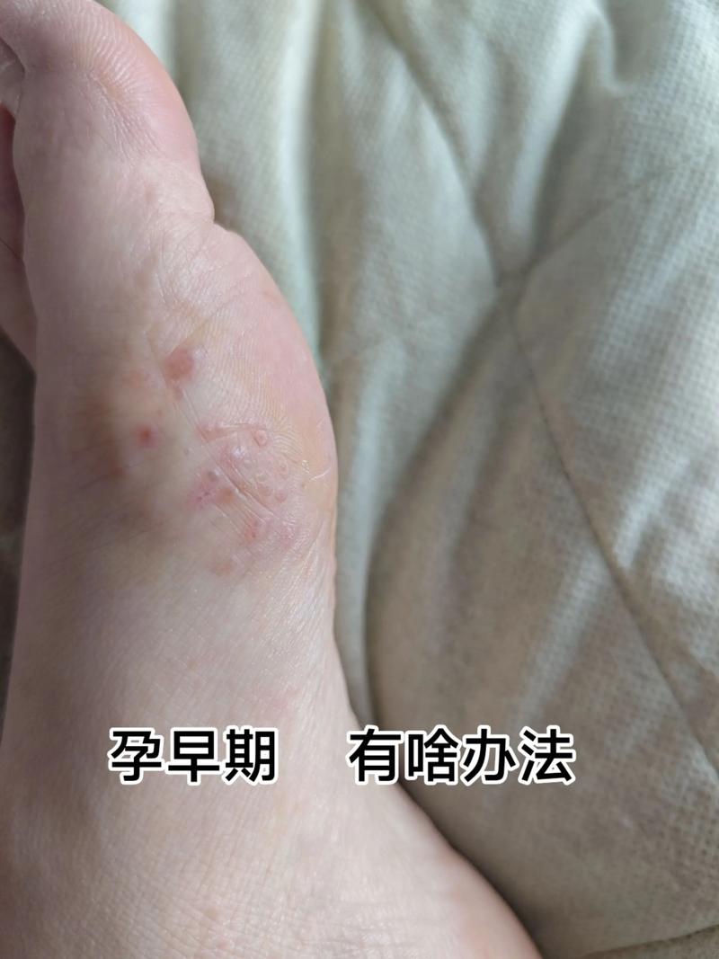 孕期脚丫莫名起泡是缺营养还是生病了？孕妈该如何应对才安全？-第1张图片-郑州医学网