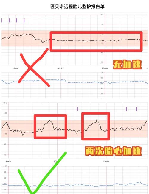 孕期胎心监护到底要做几次？不同孕周频率有何差异？-第1张图片-郑州医学网