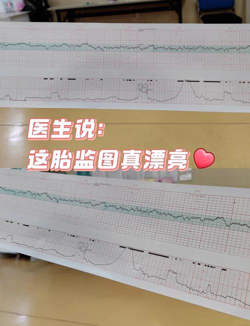 孕期胎心监护到底要做几次？不同孕周频率有何差异？-第2张图片-郑州医学网