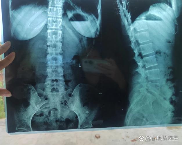 儿童强直性脊柱炎症状-第2张图片-郑州医学网