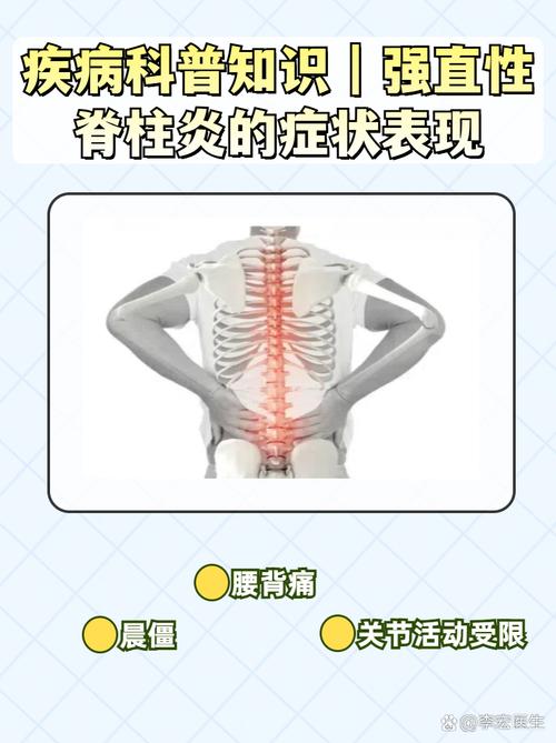 儿童强直性脊柱炎症状-第1张图片-郑州医学网