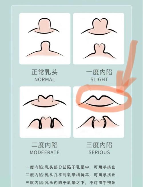 孕期乳头正常图片大全-第3张图片-郑州医学网