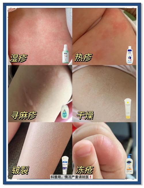 新生儿湿疹可以晒太阳-第3张图片-郑州医学网