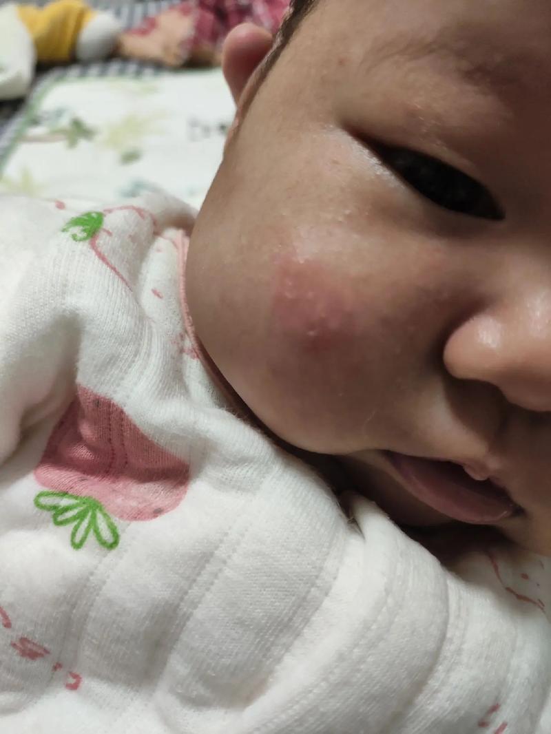新生儿湿疹可以晒太阳-第2张图片-郑州医学网