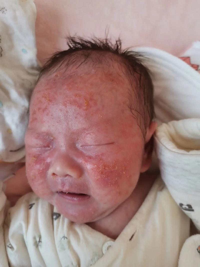 新生儿湿疹可以晒太阳-第1张图片-郑州医学网