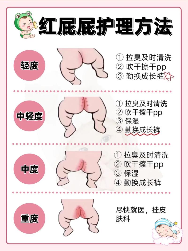 新生儿多久换次尿不湿-第3张图片-郑州医学网