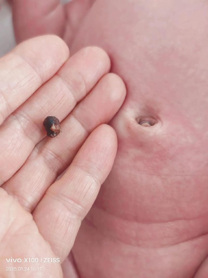 新生儿肚脐脱落后又结痂是正常现象还是异常感染？家长该如何正确护理？-第3张图片-郑州医学网