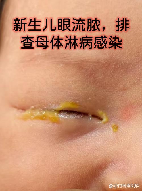 新生儿宫内感染究竟是如何发生的?有哪些高危因素与传播途径?-第1张图片-郑州医学网 新生儿宫内感染究竟是如何发生的?有哪些高危因素与传播途径?-第1张图片-郑州医学网