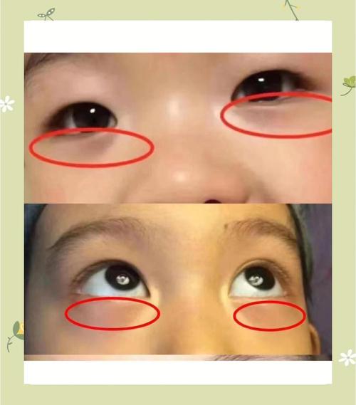 新生儿的眼睛周围发青-第3张图片-郑州医学网 新生儿的眼睛周围发青-第3张图片-郑州医学网