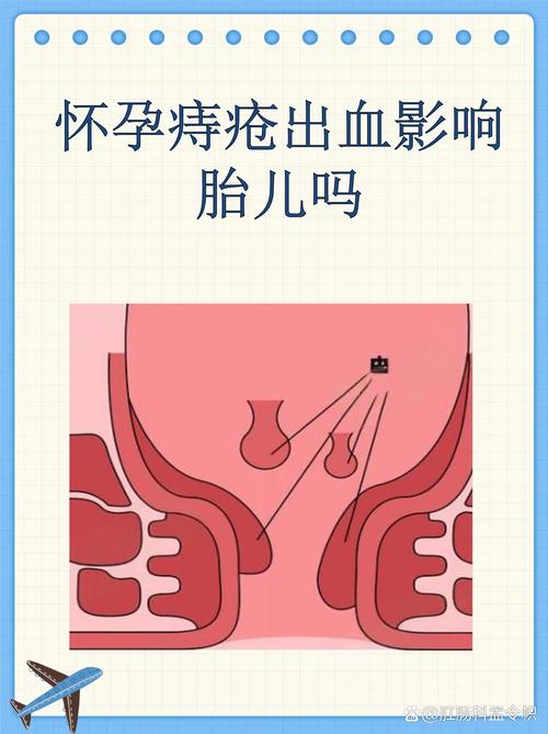 孕期痔疮出血会影响胎儿健康吗？需要如何处理才能保障母婴安全？-第1张图片-郑州医学网