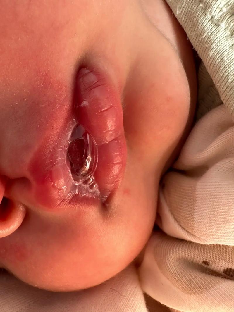 新生儿一个多月总吐泡泡是正常现象还是疾病信号？需警惕哪些潜在问题？-第1张图片-郑州医学网